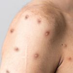 monkeypox
